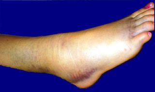 Bruised-foot